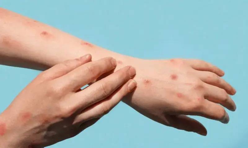 Another monkeypox case reported in Karachi, total cases rise to 11
