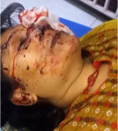 Lahore woman loses eye after brutal assault by husband 