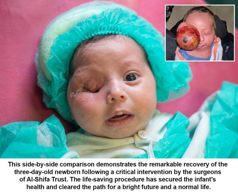 Doctors remove 285-gram eye tumour from three-day-old newborn in Rawalpindi
