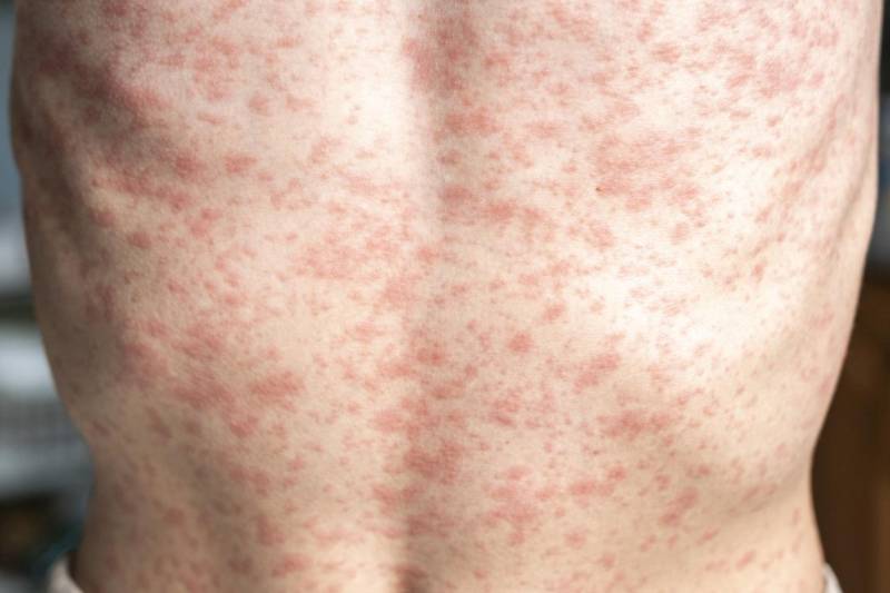 US measles outbreak ‘the worst’ in 35 years
