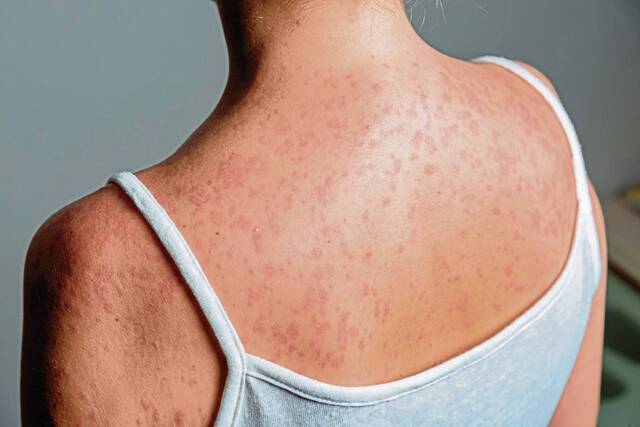 Fourth measles-related death reported in US as outbreak grows